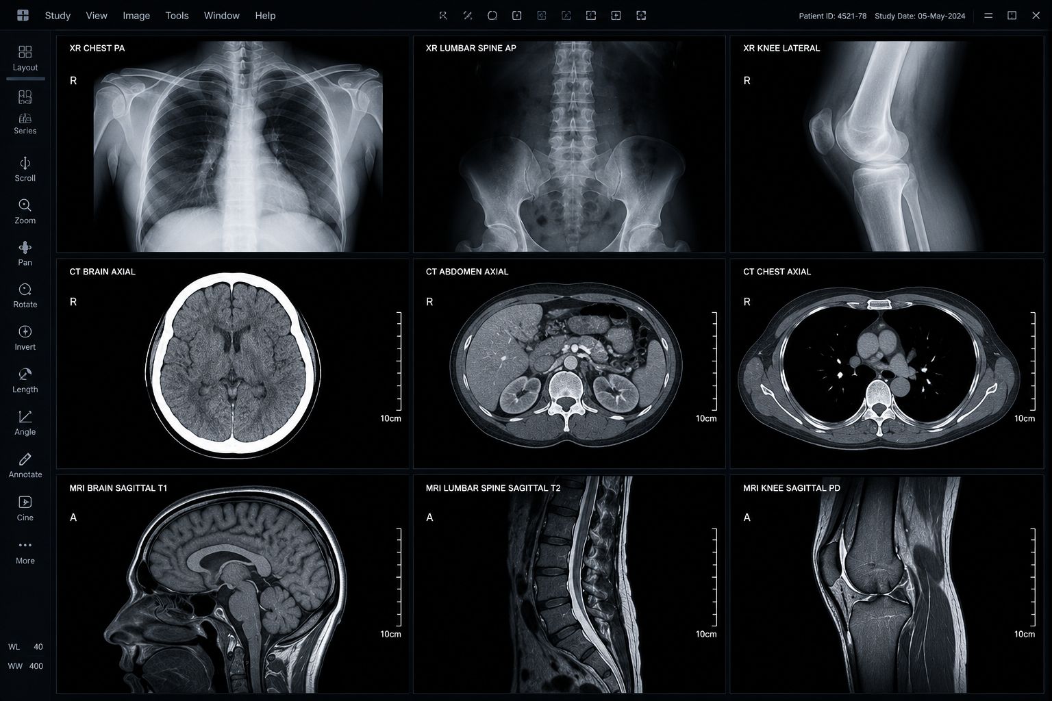 MRI